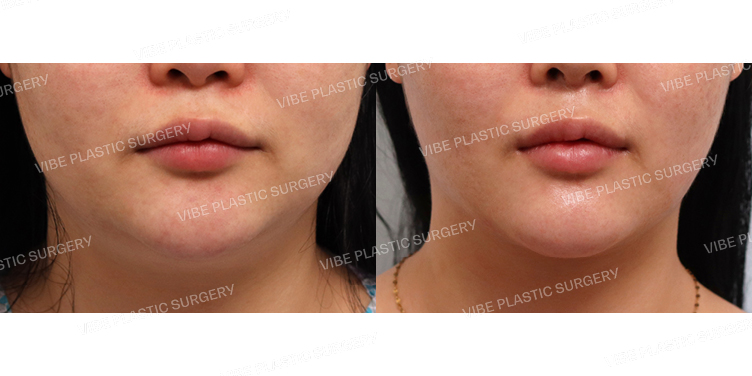 #초음파지방흡입(이중턱,턱라인)