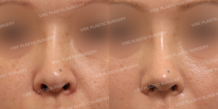 #복코 #비공내리기(재수술)