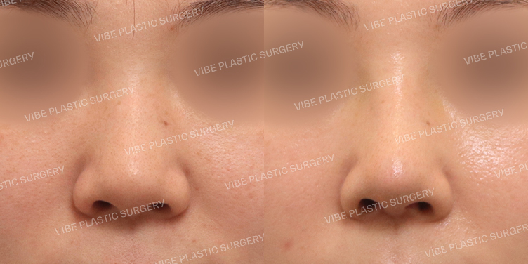 #매부리코 #복코