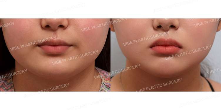 #초음파지방흡입(이중턱,턱라인)