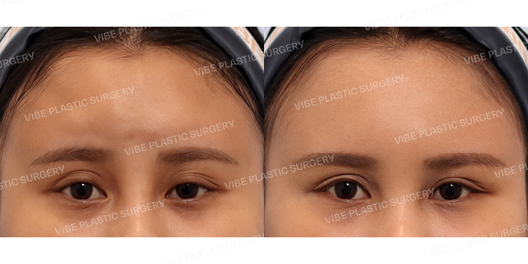 #초음파지방흡입(이마)