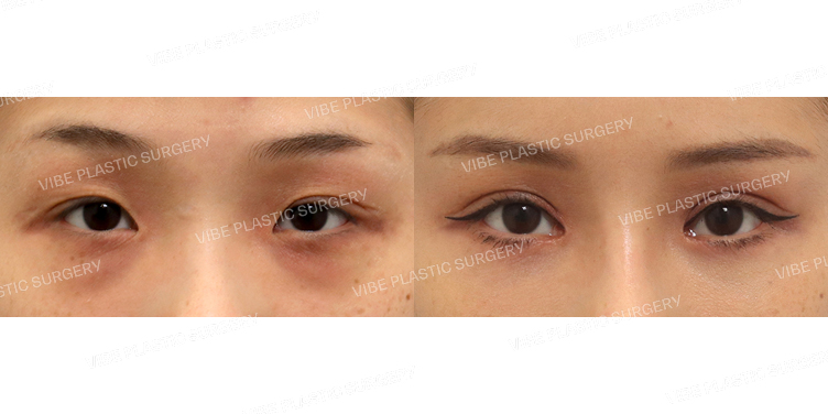 #절개눈매교정 #앞트임 #눈밑지방재배치