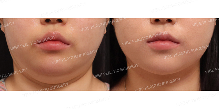 #초음파지방흡입(이중턱,턱라인)