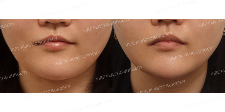 #초음파지방흡입(이중턱,턱라인)