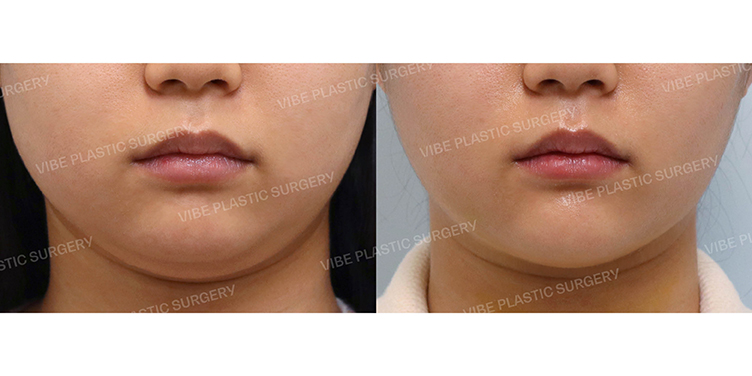 #초음파지방흡입(이중턱,턱라인) #자갈턱보톡스 #턱끝필러