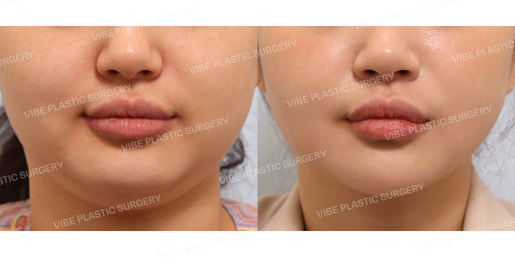 #초음파지방흡입(앞볼,이중턱,턱라인)