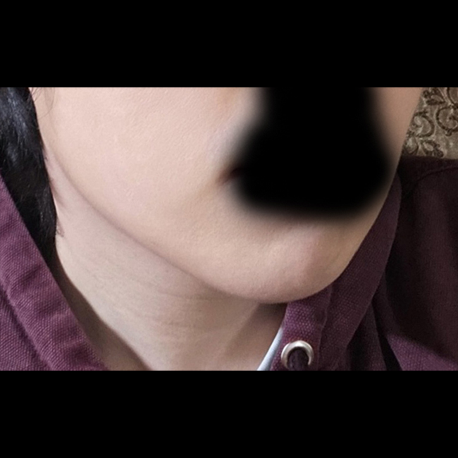 바이브 얼굴지방흡입 진짜진짜 추천~