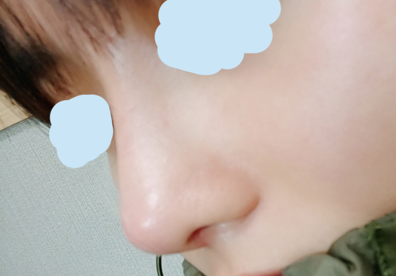 주변에서도 코재수술 잘됐다고 합니다~!