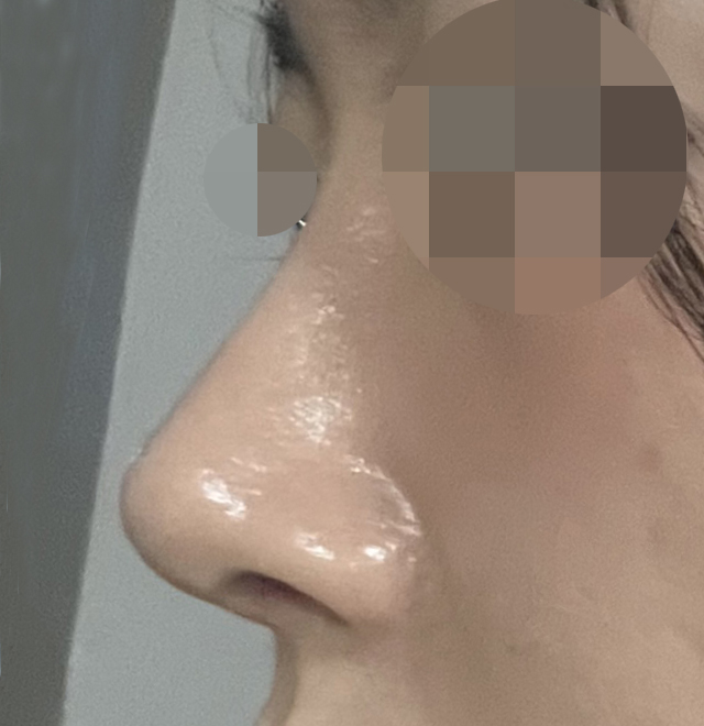 무보형물 코성형 매우매우 만족!