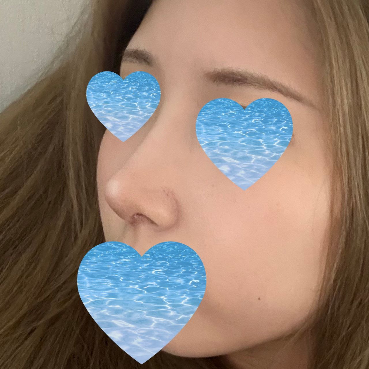 매부리코성형 성공 ㅎ.ㅎ