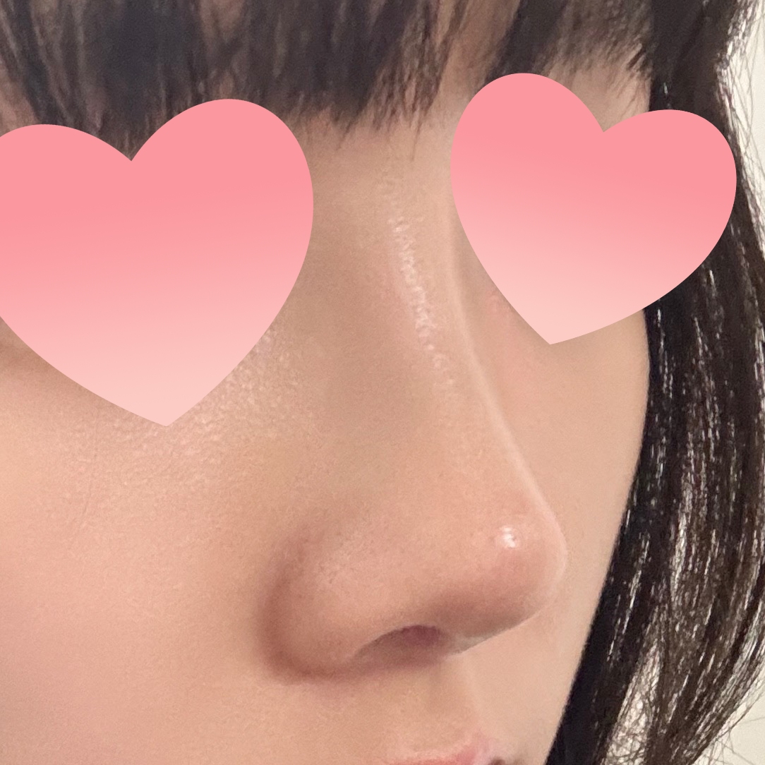 눈, 코수술받았는데 너무 조화로워용