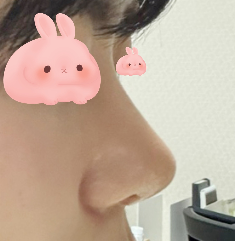 무보형물 코수술+눈밑지방재배치 했슴당