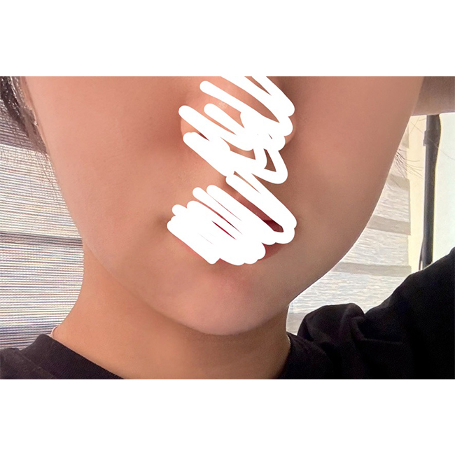 심부볼제거 효과짱짱