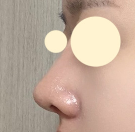 깐깐하게 선택한 바이브에서 수술 만족했어용