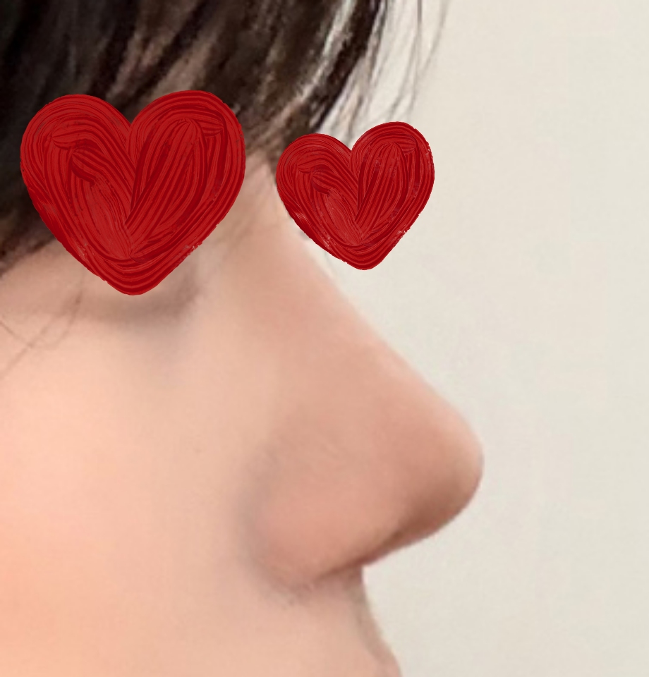 첫코수술 성공적><!