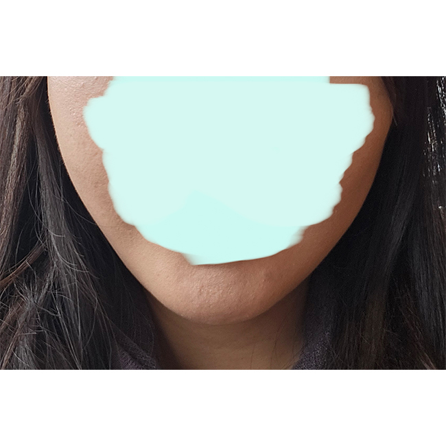 이철용원장님께 무제한 실리프팅받았어용