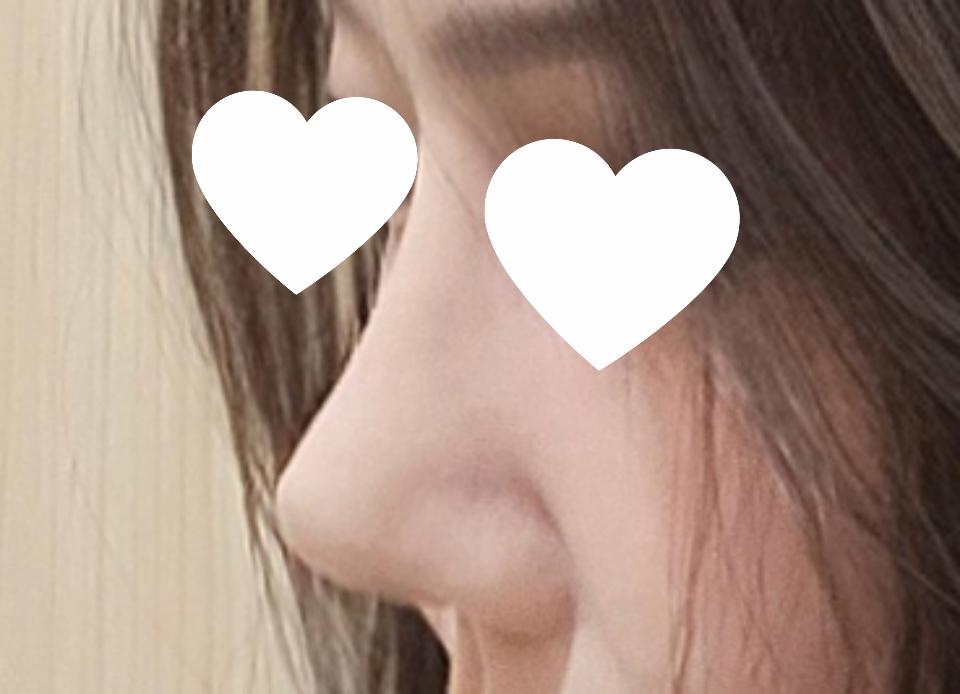 코3번째수술 벌써 2달됐네요