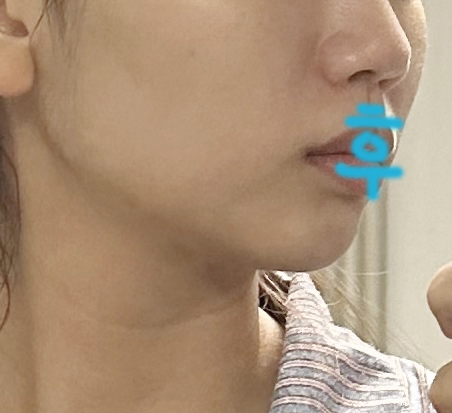 얼굴지방흡입이랑 심부볼제거한 후기!