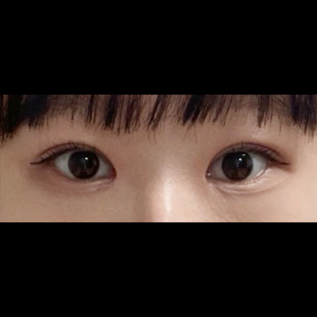 짝눈+작은눈 예쁘게 수술받고 자리잡는중!
