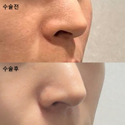 비공내리기 1개월