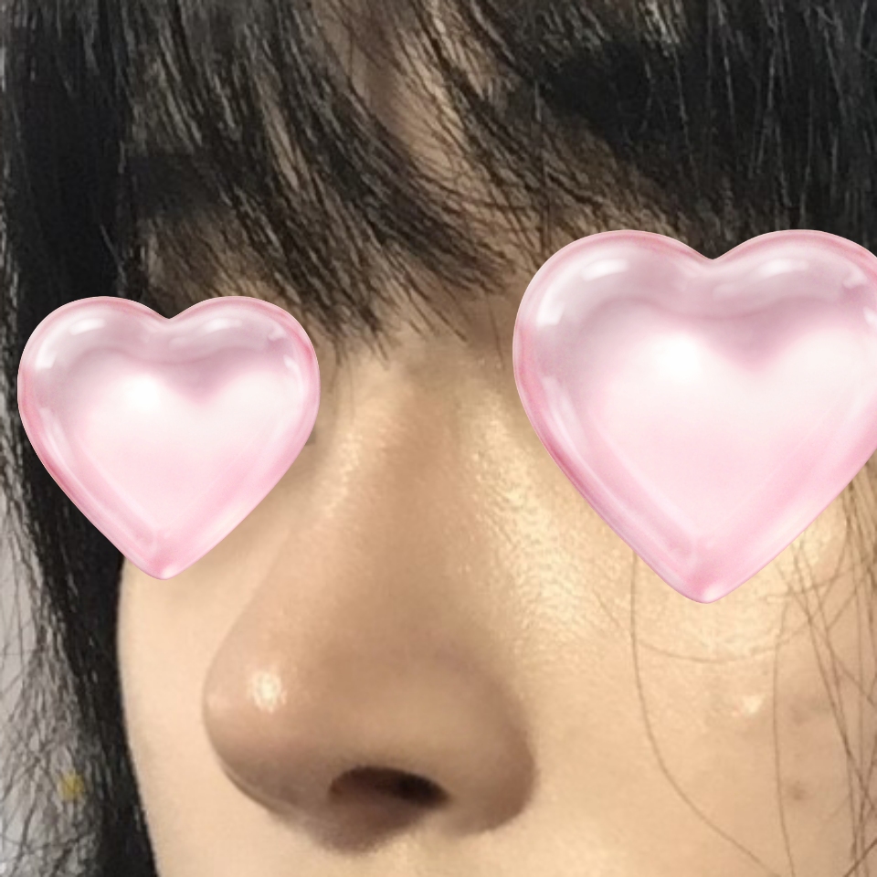 코수술 후 많이 예뻐졌어요 ㅎㅎ