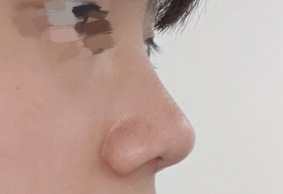 남자 매부리코 교정 바이브에서 했습니다.