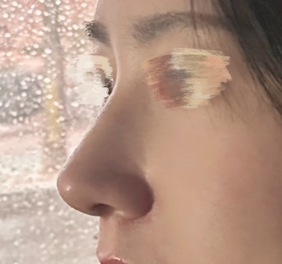 무보형물 코성형 강력추천><bb