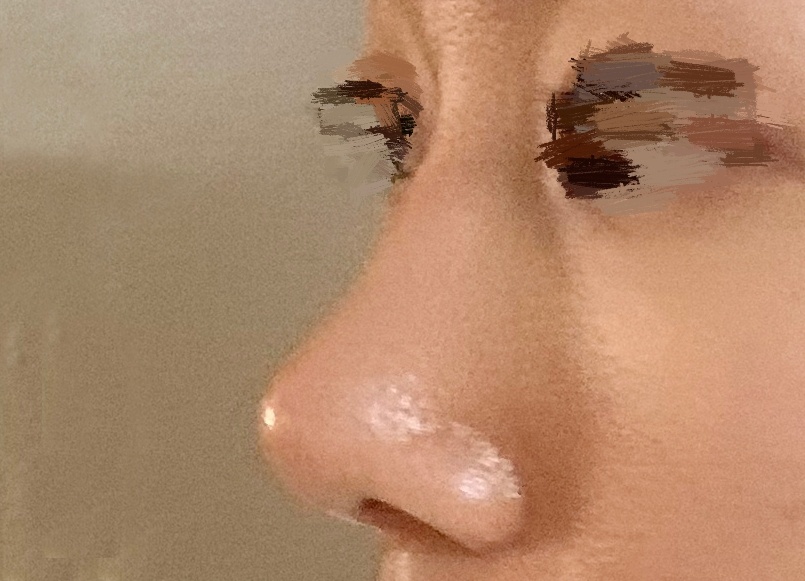 매부리코수술, 결과는 성공><