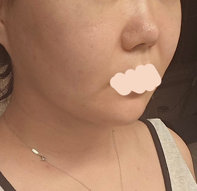 얼지흡+실리프팅+슈링크 효과 최공