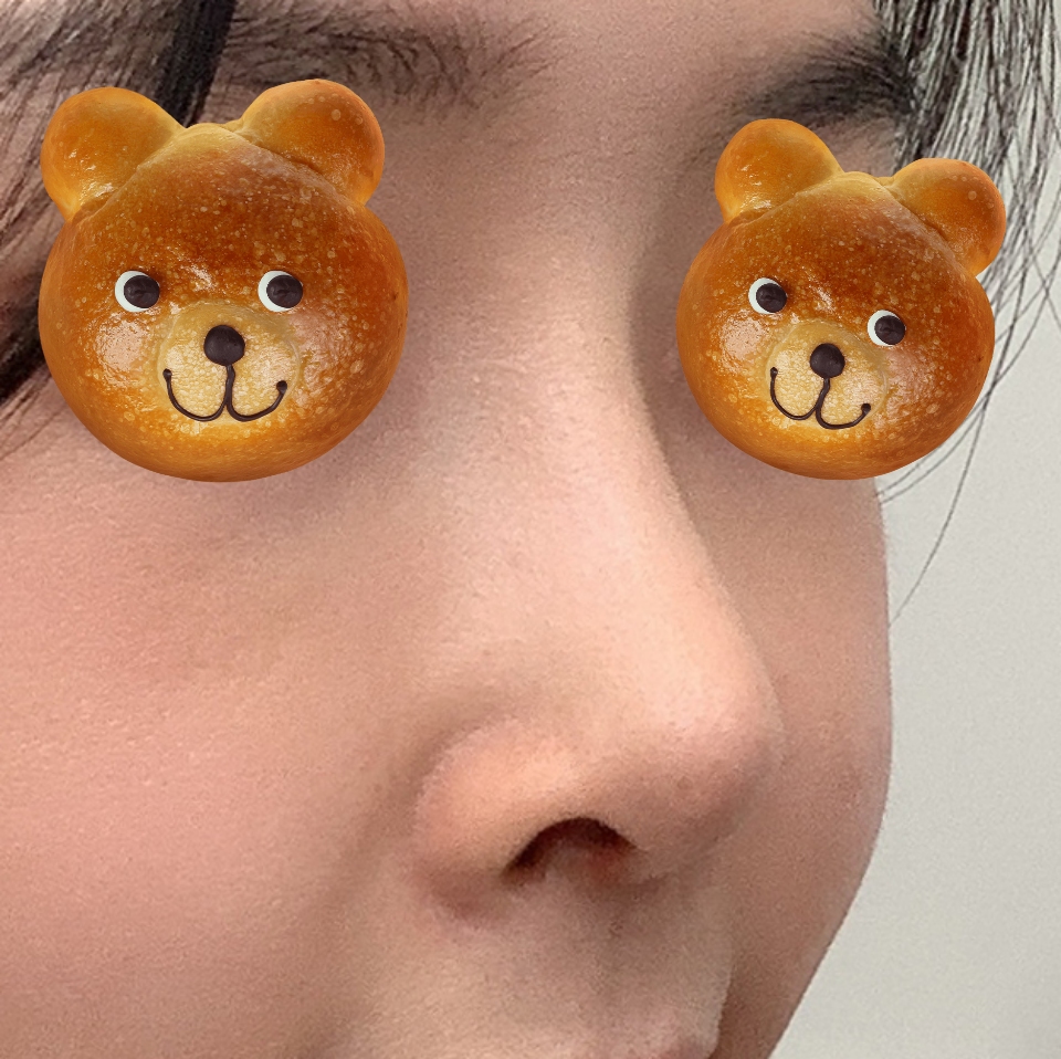 바이브에서 눈, 코수술한지 한달차!