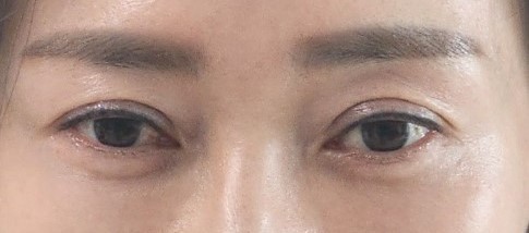 눈밑지방재배치 후기