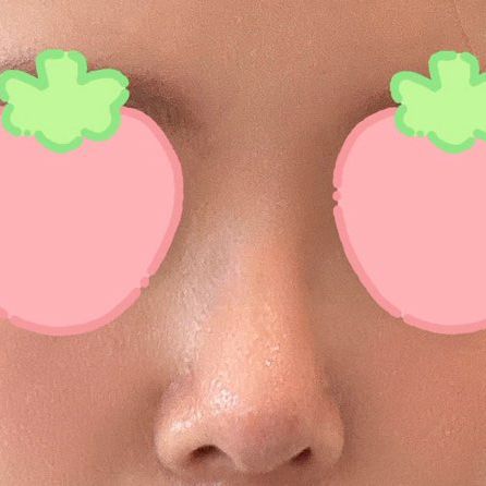 코수술 후 거울보는게 행복해요!><