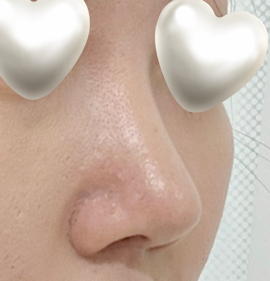 코수술잘하기로 유명하셔서 믿고 수술!