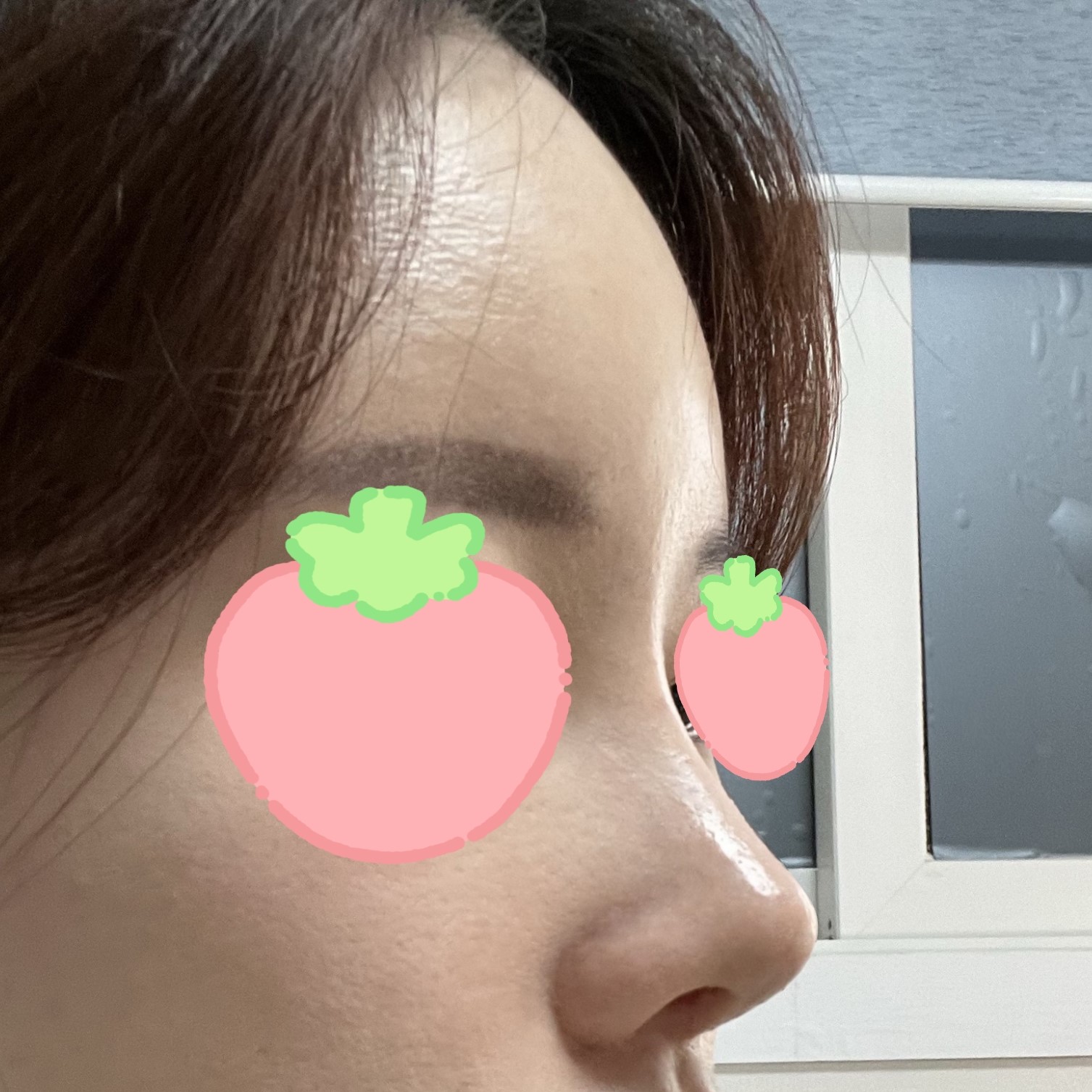 코수술 정말 잘한 선택이에용