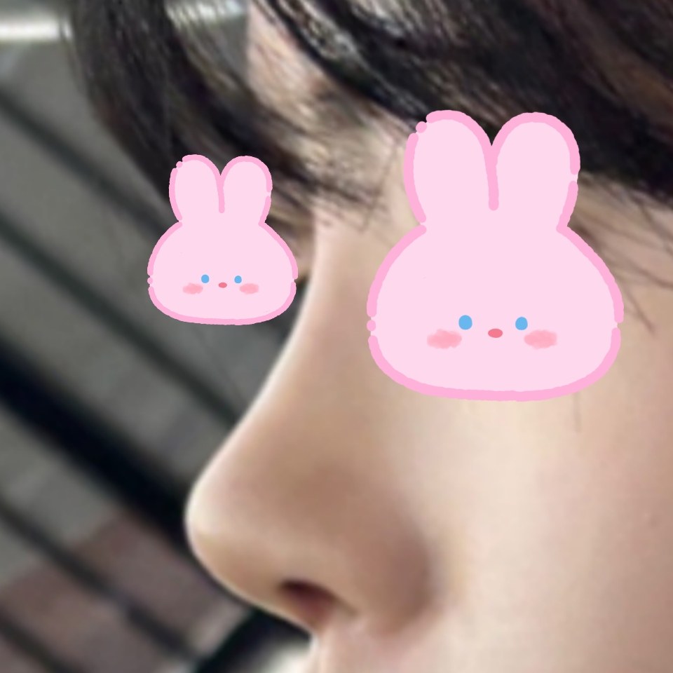 바이브에서 코수술 대만족 입니당