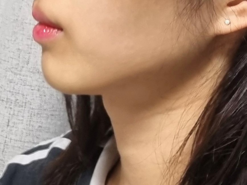 이중턱 지방흡입 다시 돌아가도 또 할 것 같아요 ! 후회 없습니당