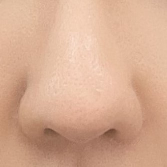 비공내리기 수술 한달 차 입니다 !