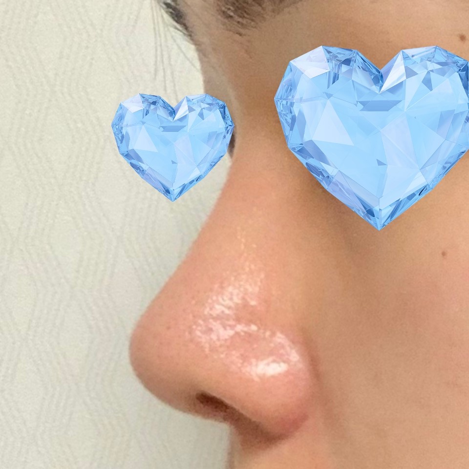 코성형은 역시 바이브입니당