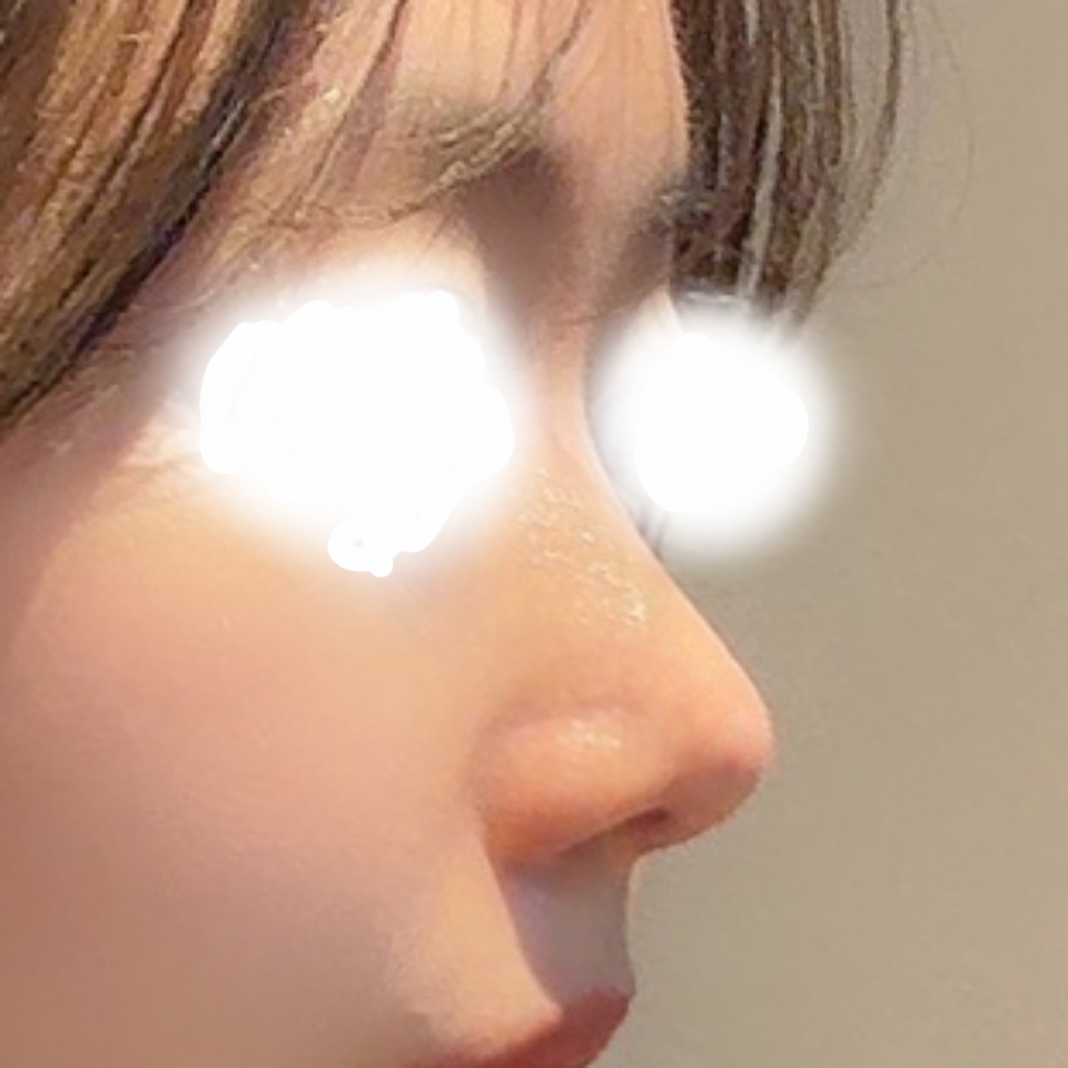 무보형물 3개월, 딱 원하는 느낌이에여 ㅎ