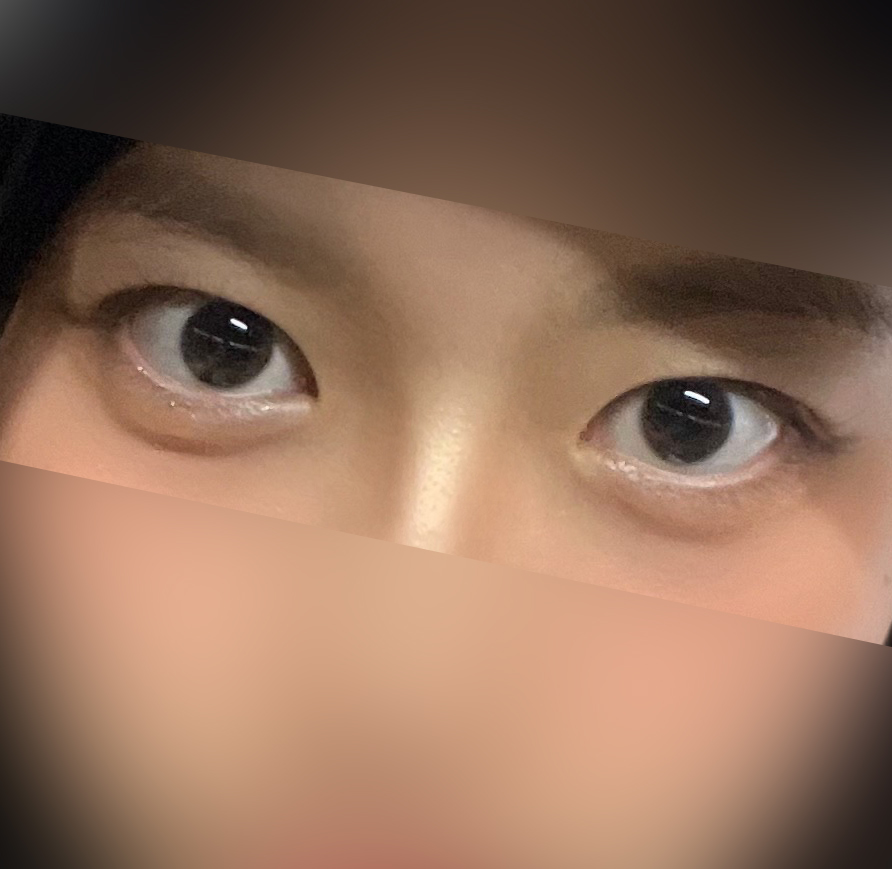 눈매교정 제대로 수술해주심!