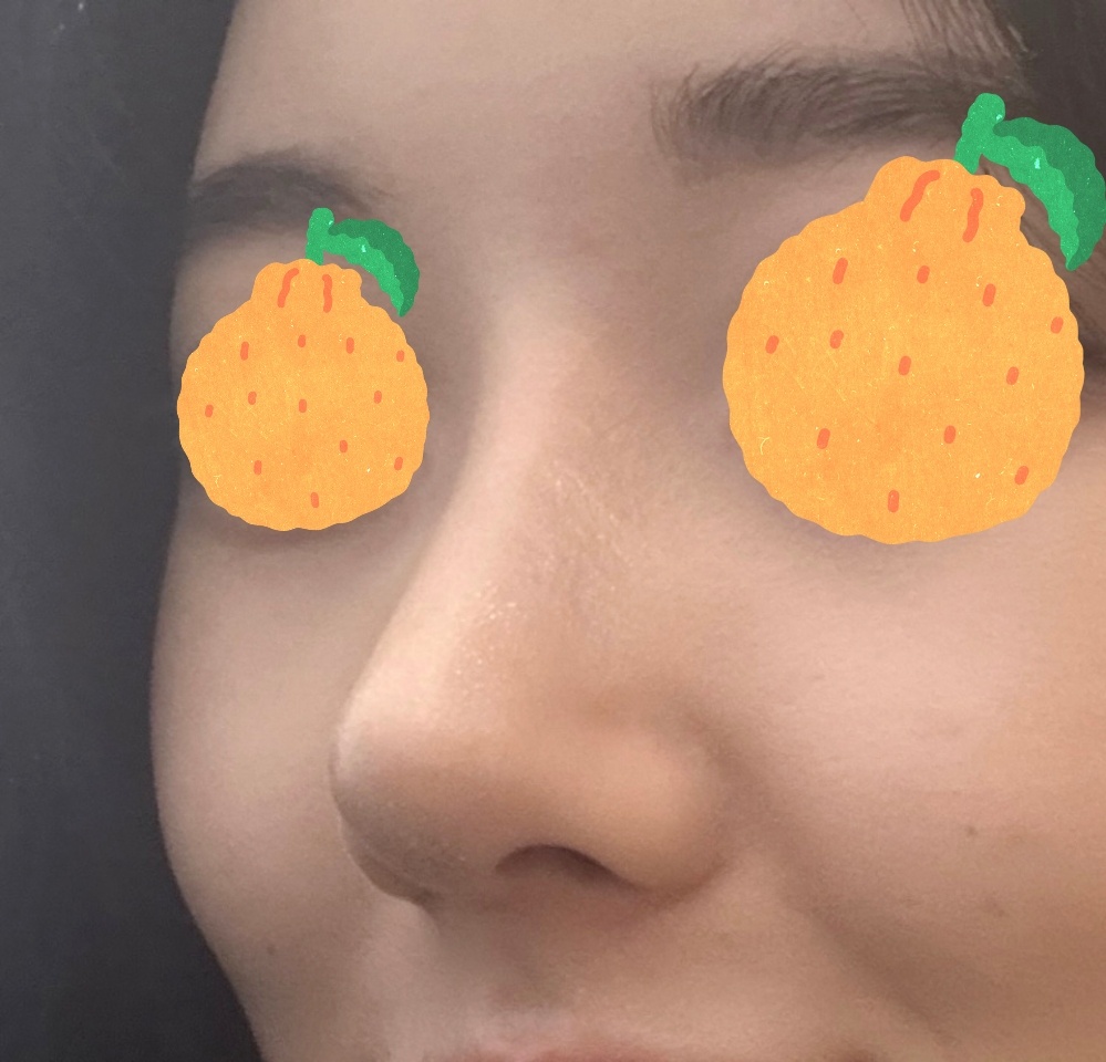 예쁘게 코수술해주신 유원장님감사합니다~