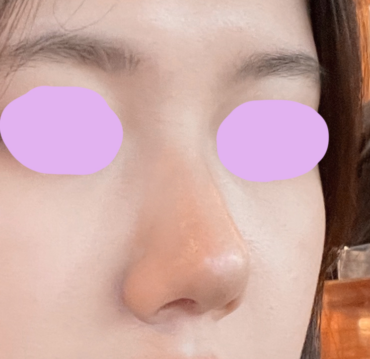 보형물사용안하고 복코교정했어욥