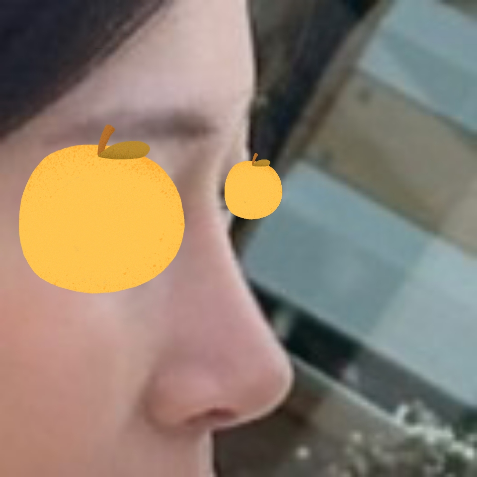 수술 하길 잘했어요 ! 너무 만족합니다