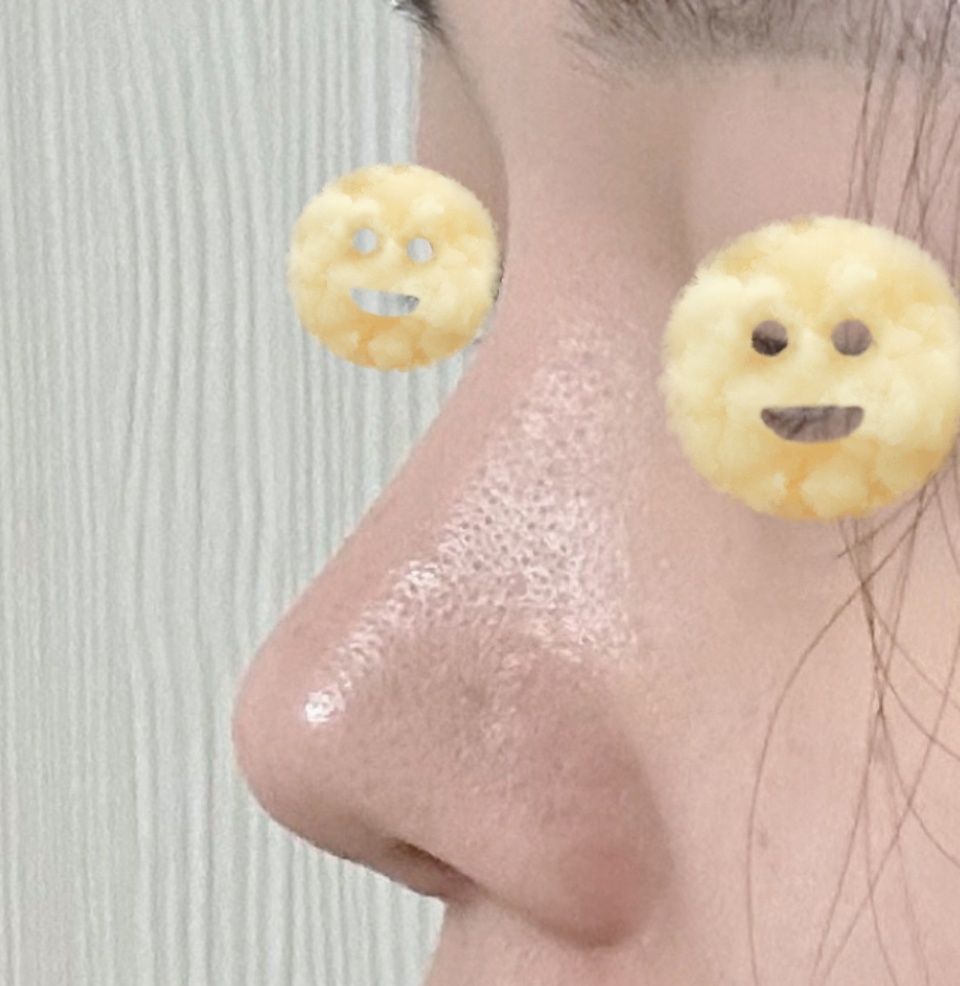 유영문원장님께 코수술받아써요