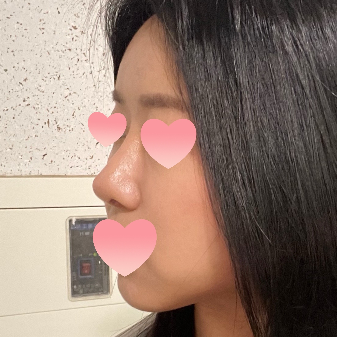 수술 잘 돼서 너무 만족스럽습니다