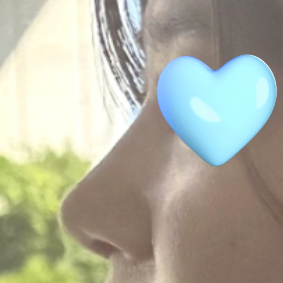 유영문 원장님께 수술 받은건 신의 한수 입니당