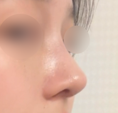 복코+매부리코성형 3주차입니당