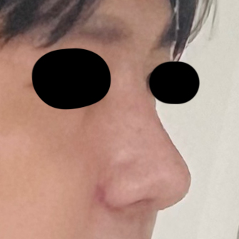 남자 코성형과 남자 눈성형