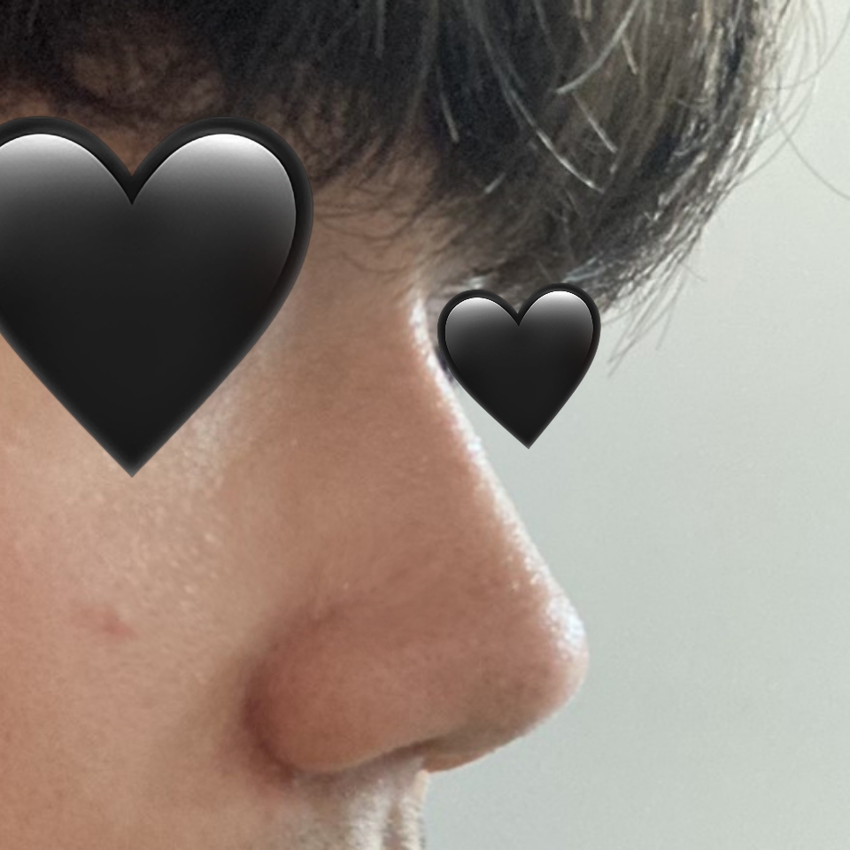 코성형 고민하시는 분들은 바이브 추천드립니다