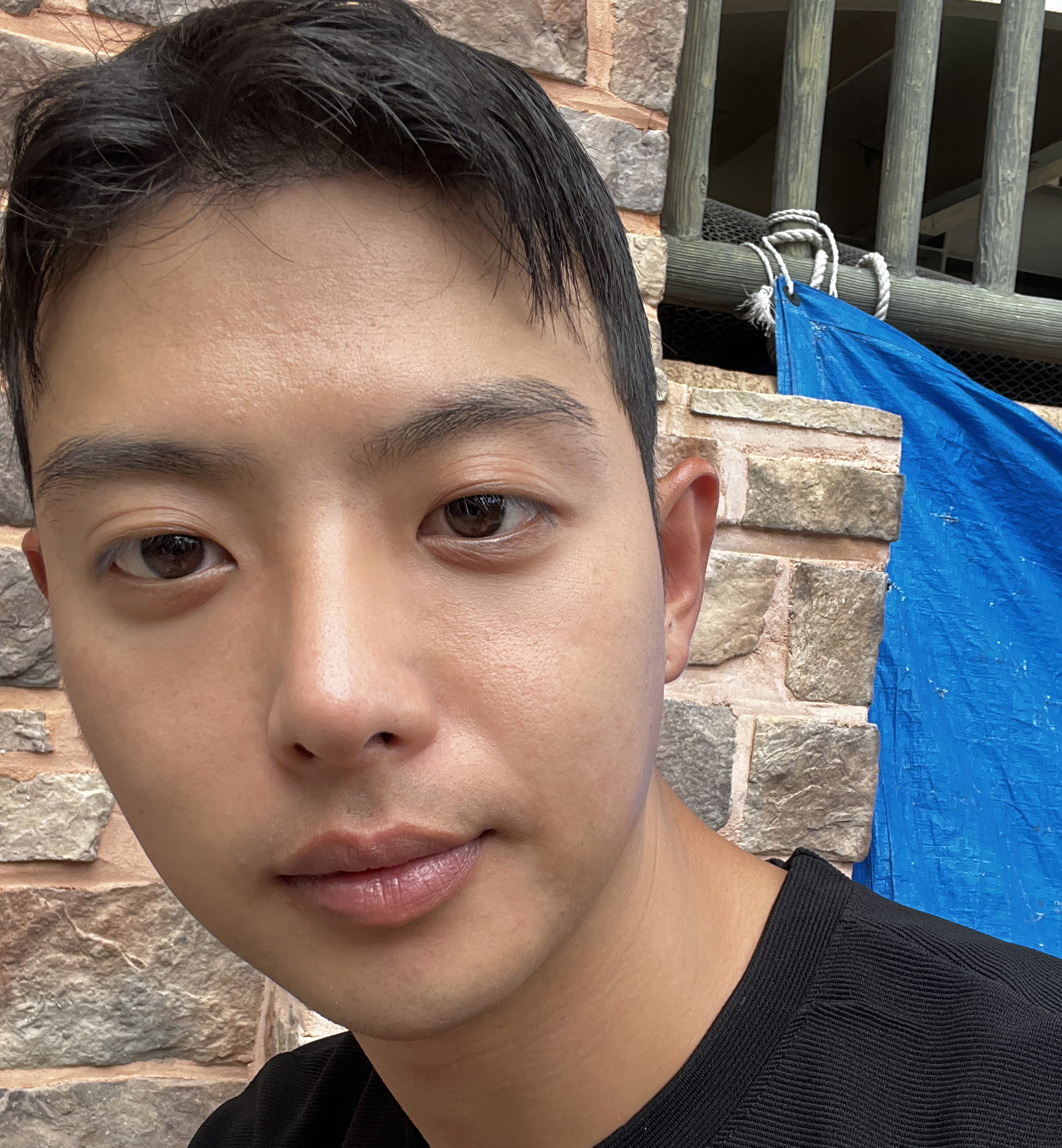 매부리코수술, 이마축소술한지 5개월차 됐네요